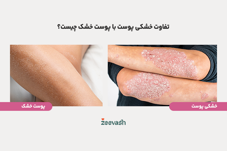 تفاوت خشکی پوست و پوست خشک